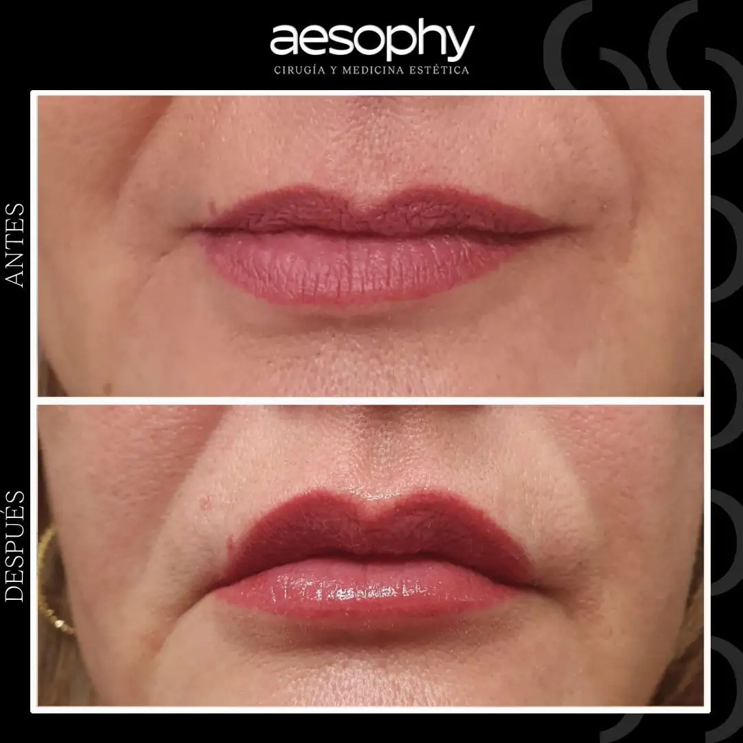 Antes y después marcación mandibular Málaga Clínica Aesophy