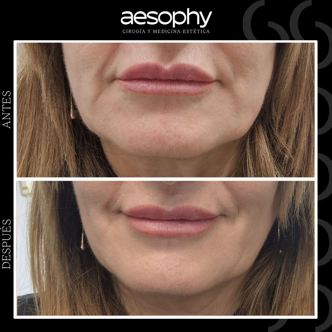 Antes y después marcación mandibular Málaga Clínica Aesophy