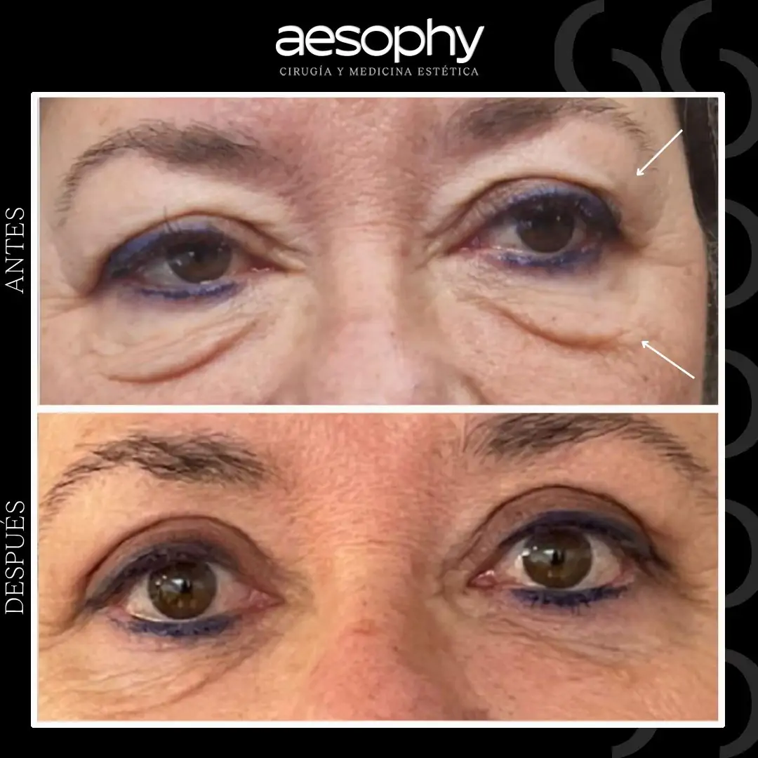 Blefaroplastia Málaga