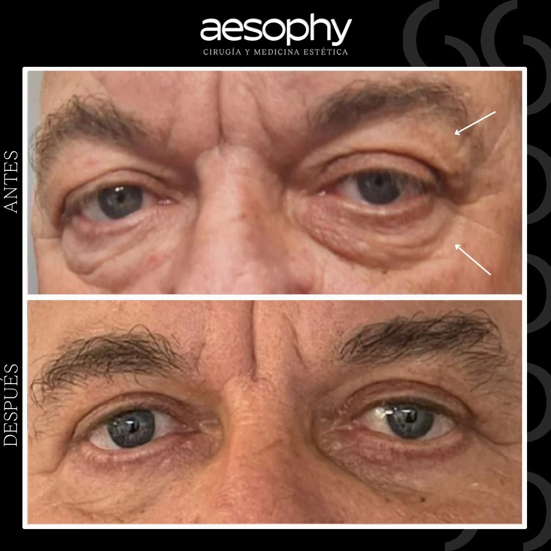 Blefaroplastia Málaga